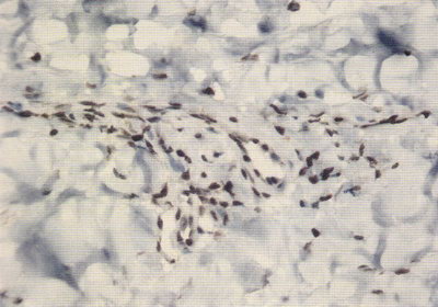 CD25+ клетки в периваскулярных инфильтратах кожи больных ограниченной склеродермией.